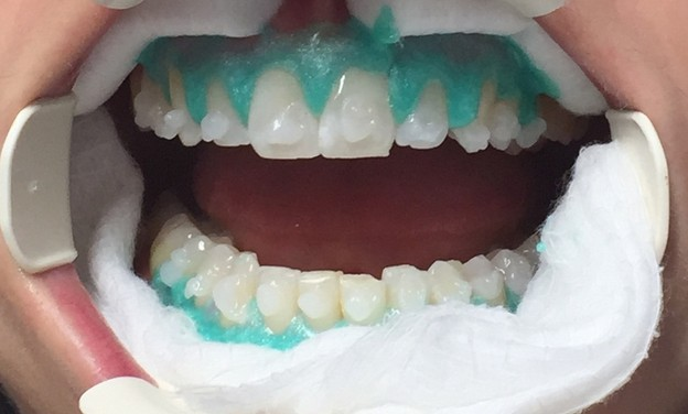 مواد سفید کننده دندان