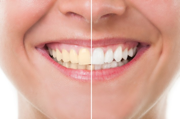 قبل و بعد از بلیچینگ دندان