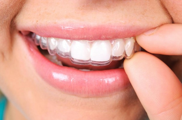 ارتودنسی نامرئی دندان