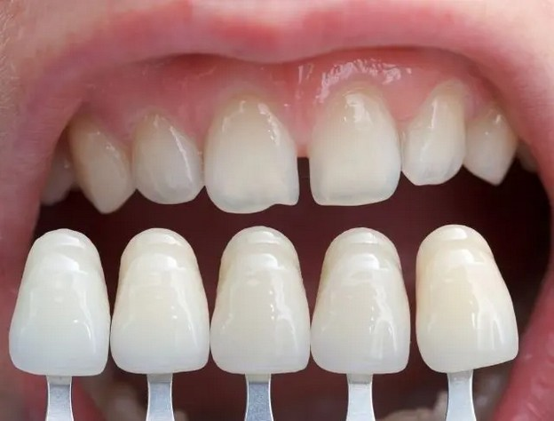 دندان قبل از کامپوزیت