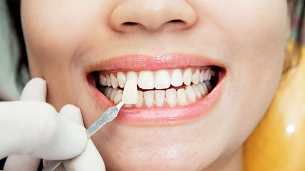 چسباندن کامپوزیت دندان