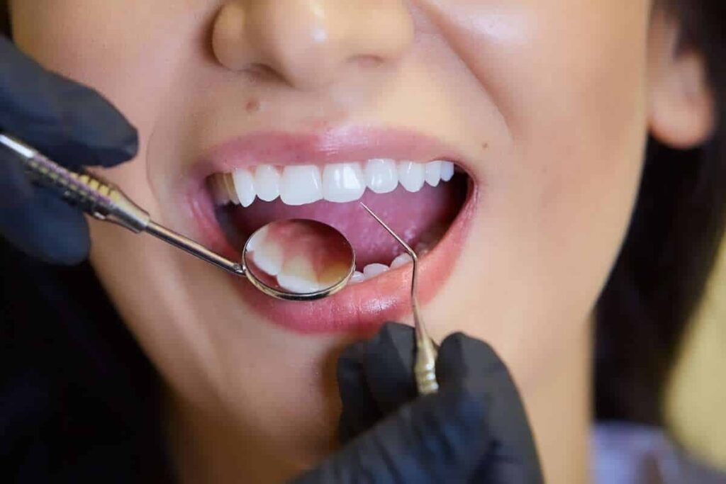 جرم گیری دندان چه مضراتی دارد